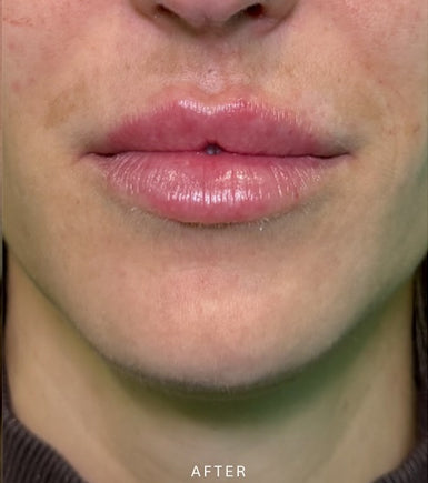 After Treatment