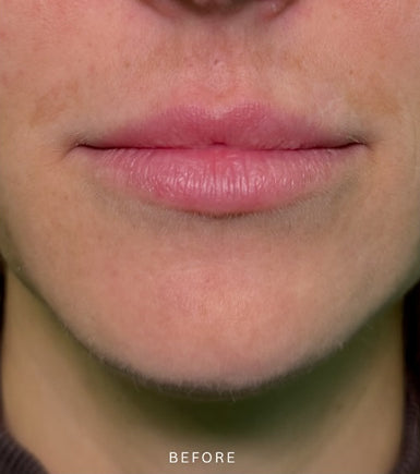 Before Treatment