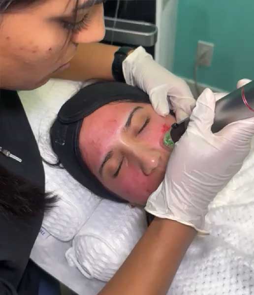 Genius RF Microneedling