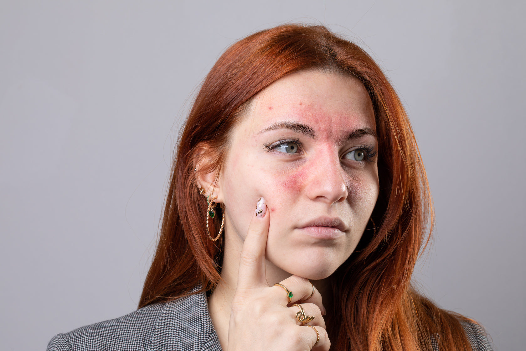 Understanding and Managing Facial Redness & Rosacea