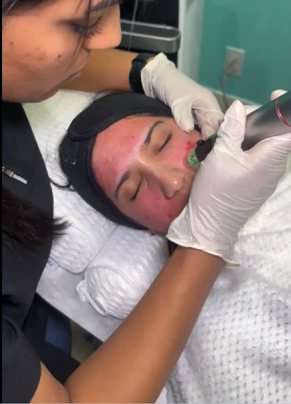 Genius RF Microneedling