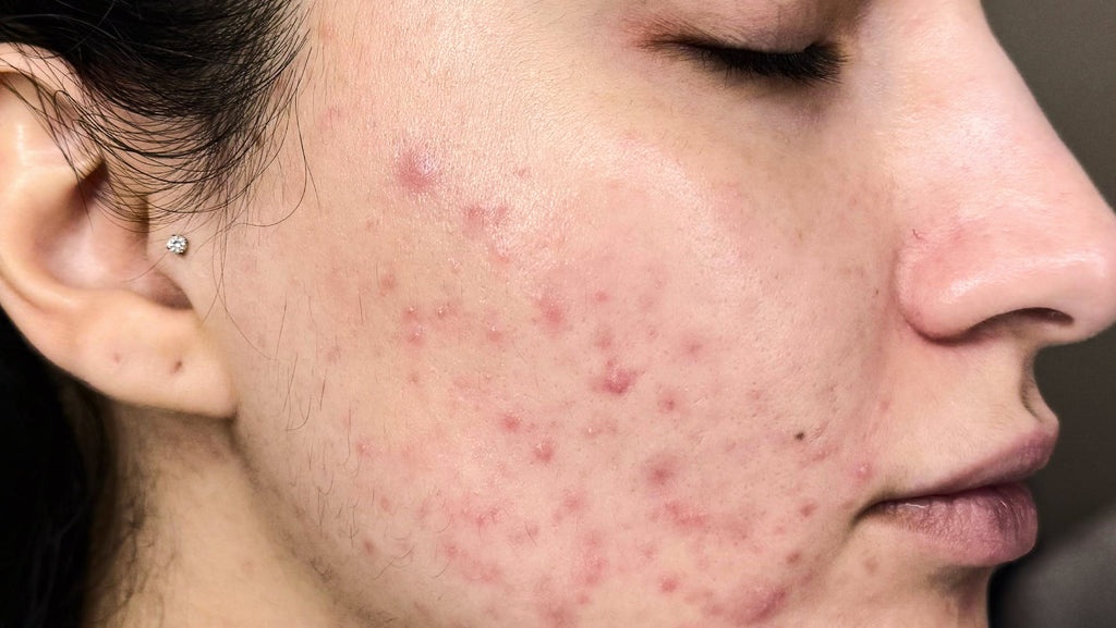 Chemical Peels for Acne: A Clinical Approach to Managing Breakouts