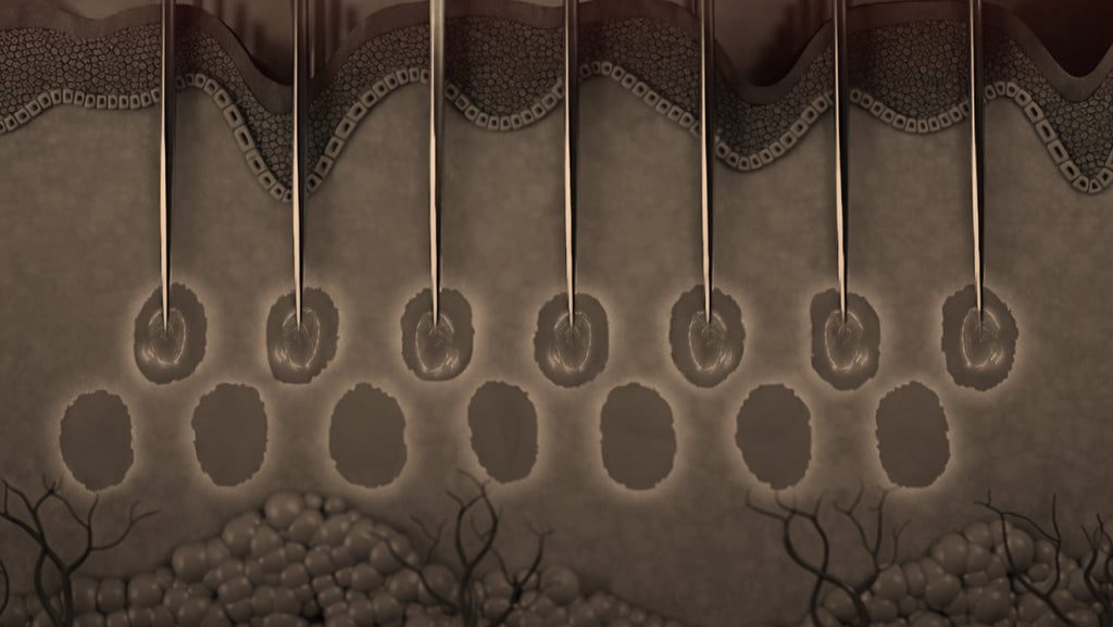 Microneedling in Richmond BC: What You Need to Know