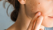 Aerolase for Acne Scars: Why the Right Treatment Starts With the Right Diagnosis