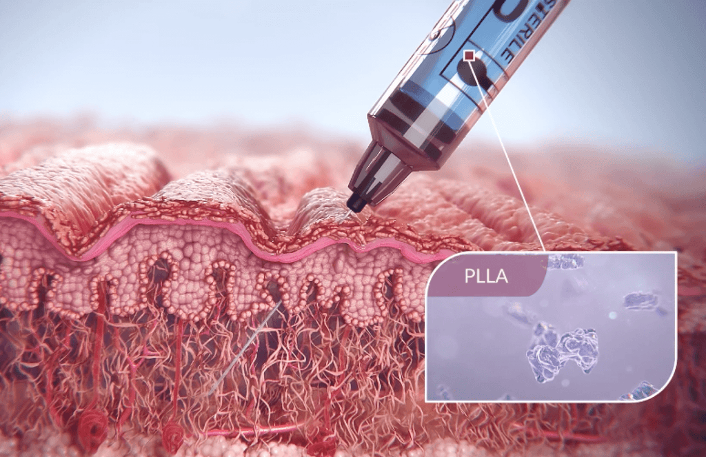 Biostimulators (Sculptra)